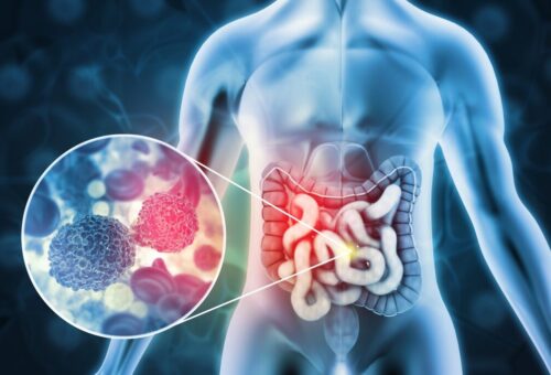Colon cancer illustration