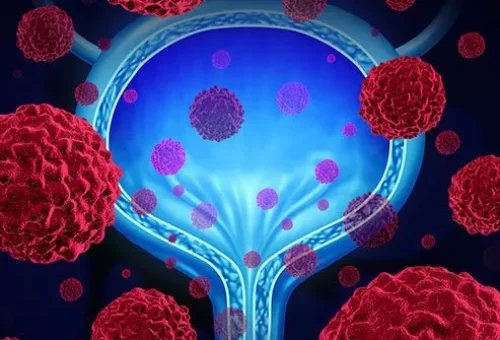 bladder-cancer
