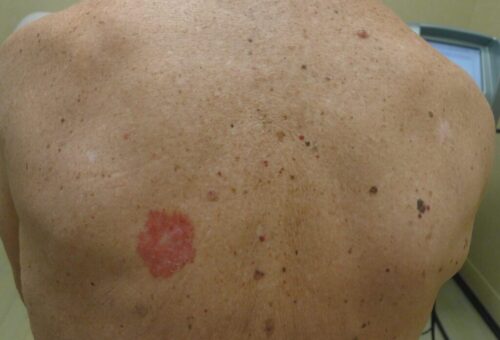 skin-cancer-on-back-