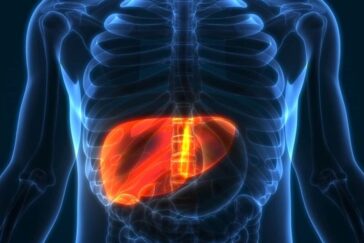 NAFLD